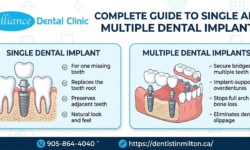Dental Implants: Complete Guide to Single and Multiple Dental Implants