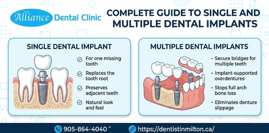 Dental Implants: Complete Guide to Single and Multiple Dental Implants