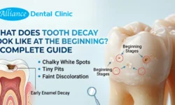 What Does Tooth Decay Look Like at the Beginning? A Complete Guide