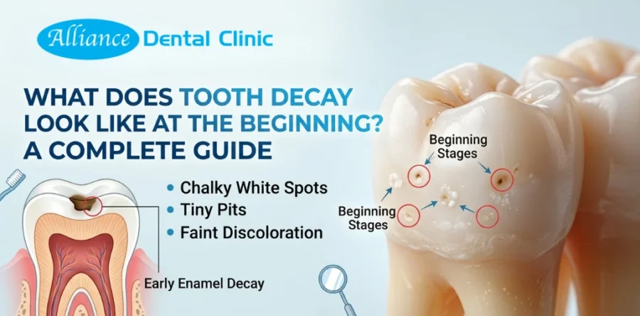 What Does Tooth Decay Look Like at the Beginning? A Complete Guide