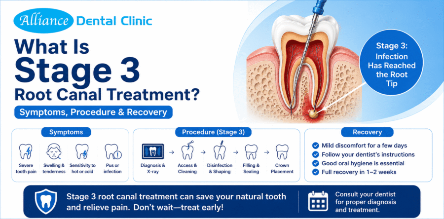 What Is Stage 3 Root Canal Treatment? Symptoms, Procedure & Recovery
